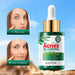 30ml Tea Tree Acne Removing Face Essence Oil Controlling Acne Printing Skin Care Product Moisturizing Facial Anti Acne Essence