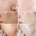 3pcs/Set Salicylic Acid Oil Control Acne Removing Skin Care Sets Serum Facial Anti Acne Removal Moisturizing Face Skin Care Kit-Health Wisdom™